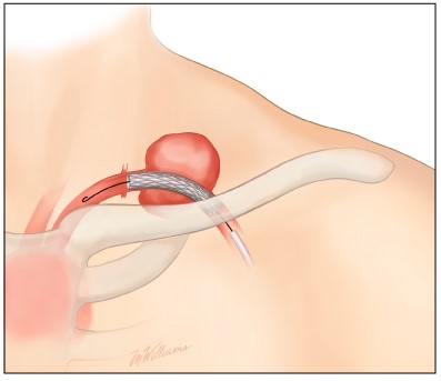ترمیم آسیب عروقی شریان سابکلاوین(زیرترقوه ای) به روش اندوواسکولار Endovascular Repair of Subclavian Artery Injury
