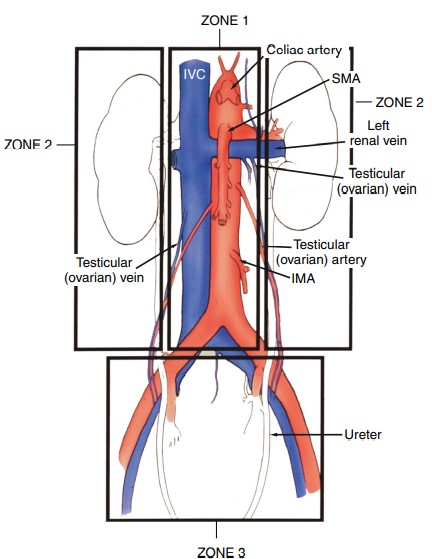 نواحی 4 گانه آناتومی عروق شکم در فضای خلف صفاقی Vascular Anatomy of Abdomen: Retroperitoneal Areas (Zones)