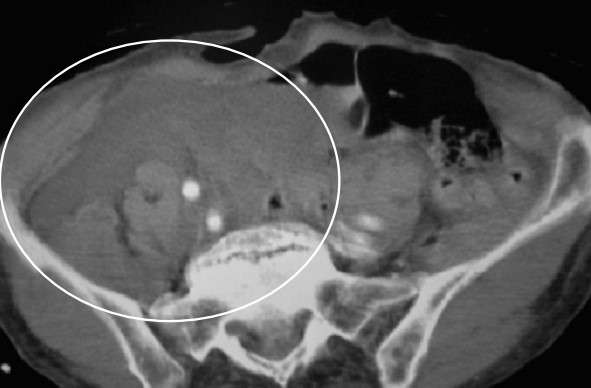 هماتوم بزرگ لگنی به دلیل آسیب شریان ایلیاک مشترک راست در بیمار تصادف جاده ای در نمای سی تی اسکن large pelvic hematoma due to injury of the right common iliac artery in a car accident patient in CT scan