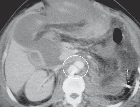 آنوریسم کاذب شریان آئورت شکمی در بیمار با زخم گلوله اسلحه جنگی در نمای سی تی اسکن بعد از عمل Abdominal aortic false aneurysm in a patient with gunshot wound in postoperative CT scan