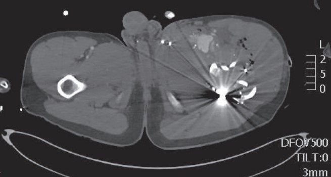 سودوآنوریسم شریان فمورال عمقی همراه با هماتوم ناحیه ران در نمای سی تی آنژیوگرافی Computed tomography angiography image demonstrating pseudoaneurysm of a profunda femoris artery (PFA) branch with thigh hematoma