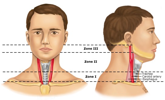 نواحی آناتومیک گردن در آسیب های نافذ گردن Anatomic Zones of the Neck for Penetrating Neck Injuries