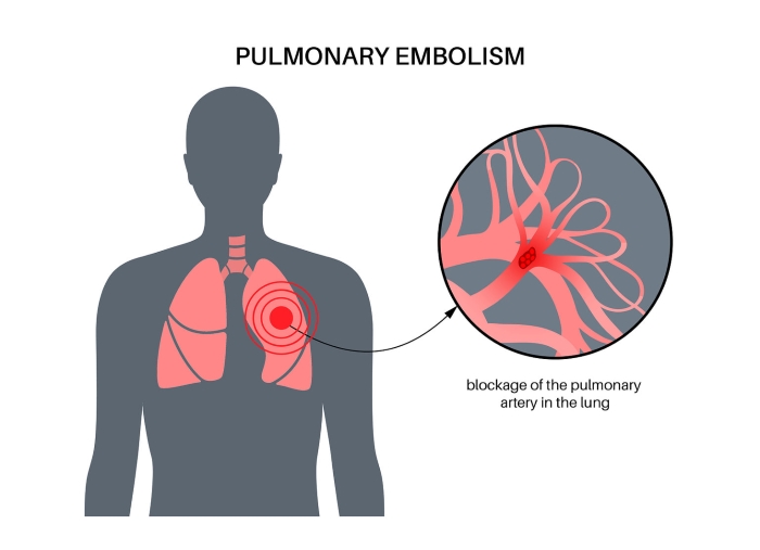آمبولی ریوی Pulmonary Embolism