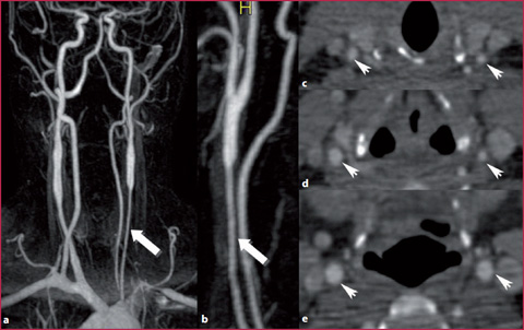 تنگی دو طرفه شریان های کاروتید داخلی ناشی از واسکولیت در نمای MRI و سی تی آنژیوگرافی Vasculitis-induced Bilateral Internal Carotid Stenosis in MRI and CT Angiography