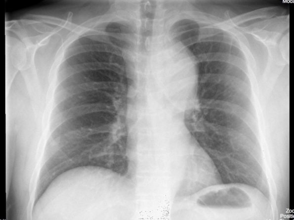 دایسکشن و پهن شدن آئورت در نمای رادیوگرافی قفسه سینه Aortic Widening and Dissection in Chest X-Ray