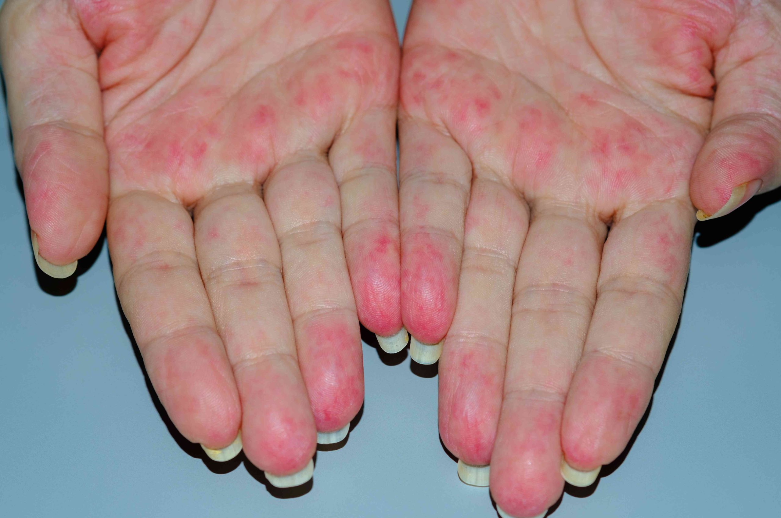 ضایعات پوستی در واسکولیت Skin Lesions in Vasculitis