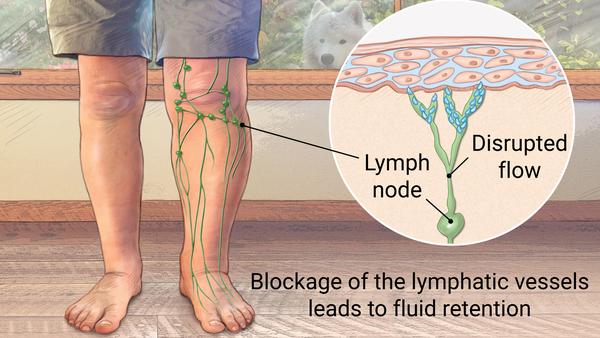 ادم لنفاوی به علت انسداد عروق لنفاوی Lymphedema due to blockage of Lymphatic vessels
