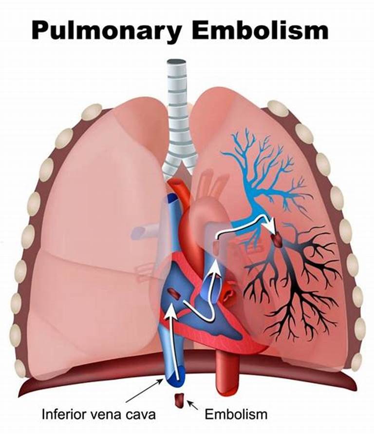 آمبولی ریوی Pulmonary Embolism
