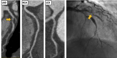 آترواسکلروز در عروق کرونری در نمای آنژیوگرافی و سی تی آنژیوگرافی Coronary Atherosclerosis in Angiography and CT Angiography