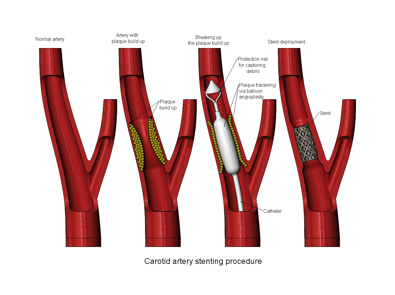 استنت گذاری در شریان کاروتید Carotid Artery Stenting
