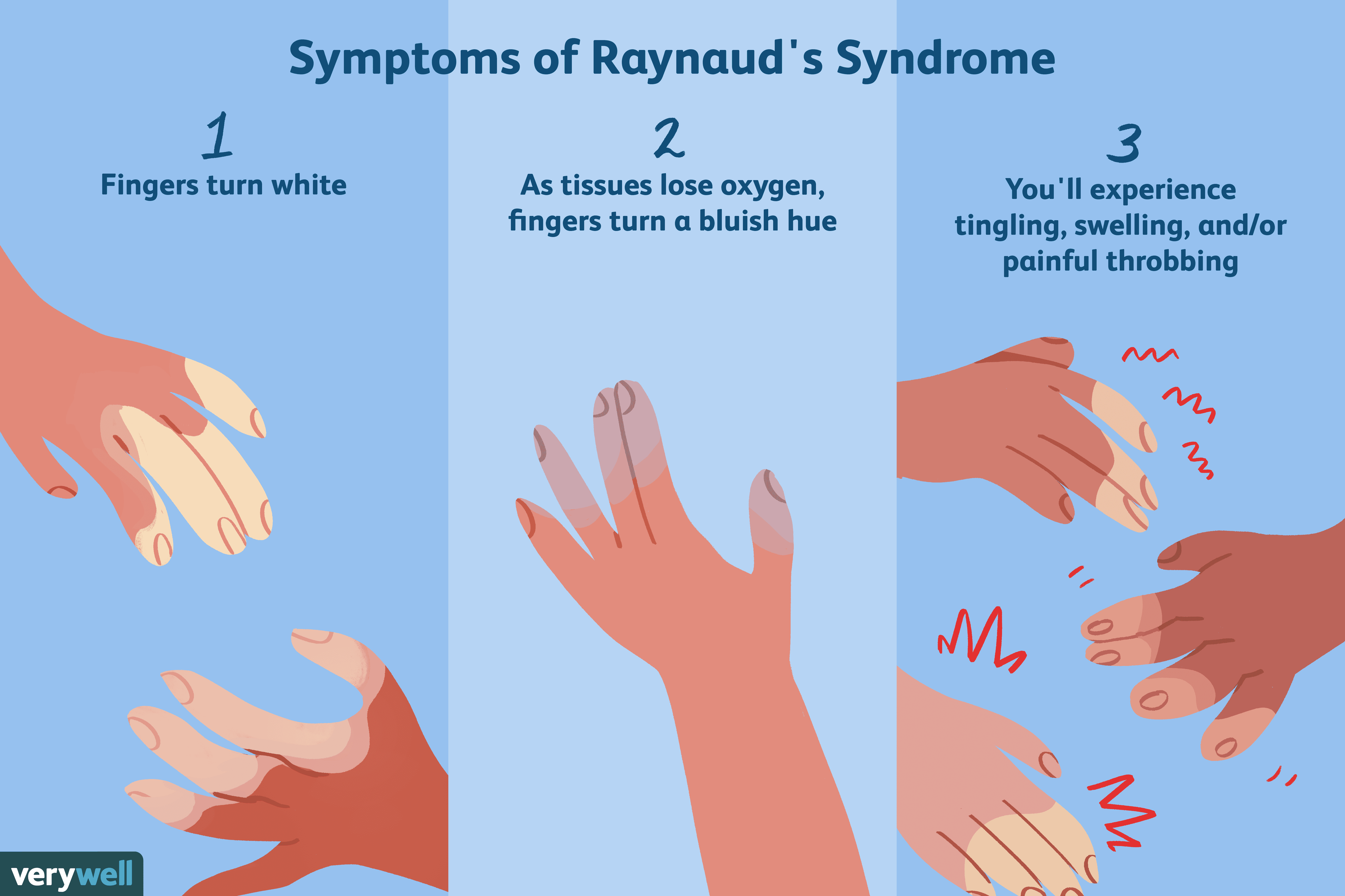 علائم پدیده رینود Symptoms of Raynaud Phenomenon