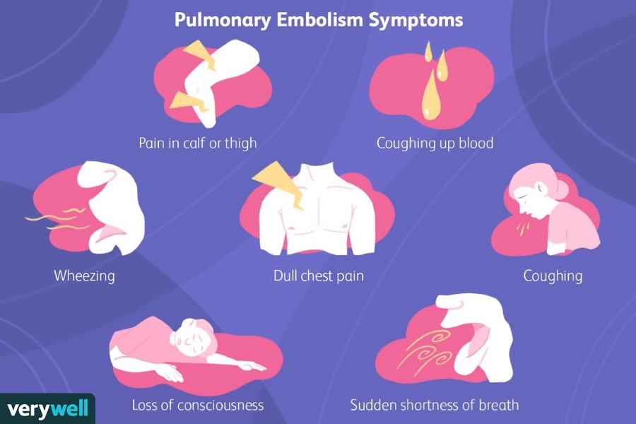 علائم آمبولی ریوی Pulmonary Embolism Symptoms