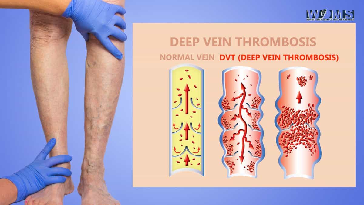 ترومبوز ورید عمقی و علائم آن Deep Vein Thrombosis and Its Symptoms