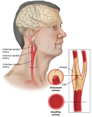 آترواسکلروز و بیماری عروق کاروتید Atherosclerosis and Carotid Artery Disease