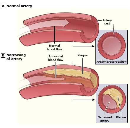 باریک شدن جدار داخلی (لومن) شریان به علت آترواسکلروز Narrowing of lumen of artery due to atherosclerosis