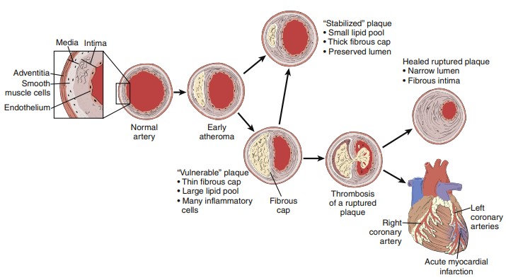چرخه حیات پلاک آترواسکلروتیک انسان Life Cycle of Human Atherosclerotic Plaque