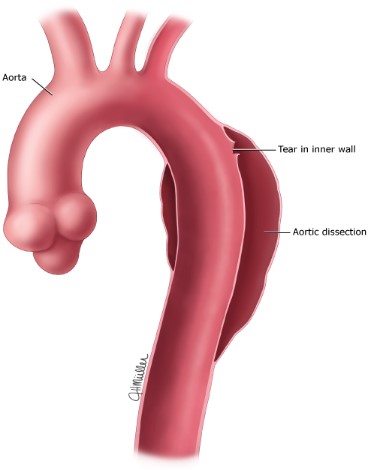 دایسکشن آئورت Aortic Dissection