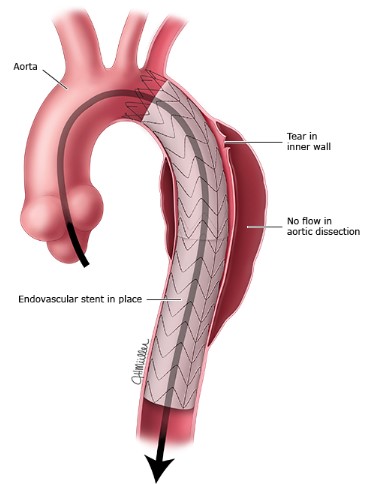 ترمیم دایسکشن آئورت نزولی با استنت گرافت به روش اندوواسکولار Descending Aortic Repair with Endovascular Stent Graft