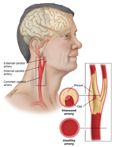 شریان های کاروتید و بیماری شریان کاروتید Carotid Arteries and Carotid Artery Disease
