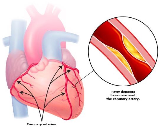 رسوب پلاک های چربی در جدار شریان های کرونری و بروز بیماری شریان کرونری Deposition of Fatty Plaques in Coronary Arteries Leads to Coronary Artery Disease