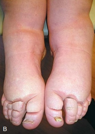 تغییرات پوستی شدید در ادم لنفاوی (نمای پوست پرتغالی و مربعی شدن انگشتان-نشانه Stemmer) Severe Skin Changes in Lymphedema ( peau d’orange Appearance and Squaring of the Toes (Stemmer’s sign))