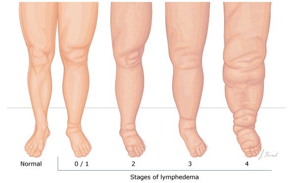 طبقه بندی ادم لنفاوی براساس معاینه بالینی Lymphedema classification by clinical examination