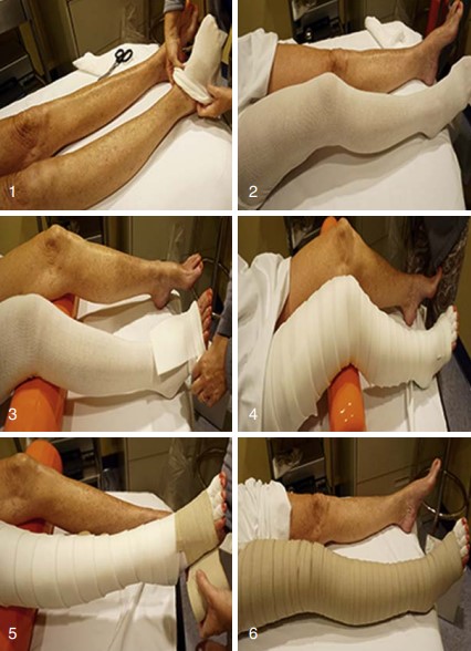 مراحل بانداژ فشاری Stages of Compression Bandaging
