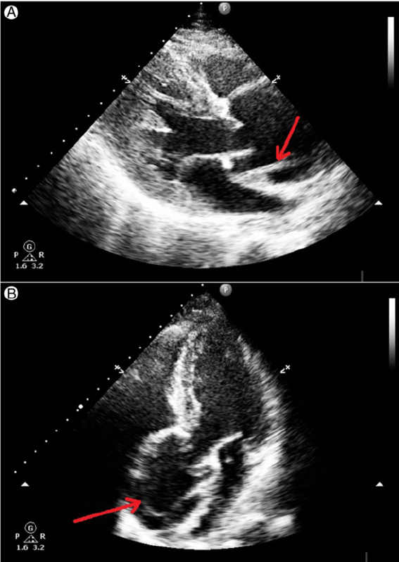 دایسکشن آئورت در نمای اکوکاردیوگرافی Aortic Dissection in Echocardiography