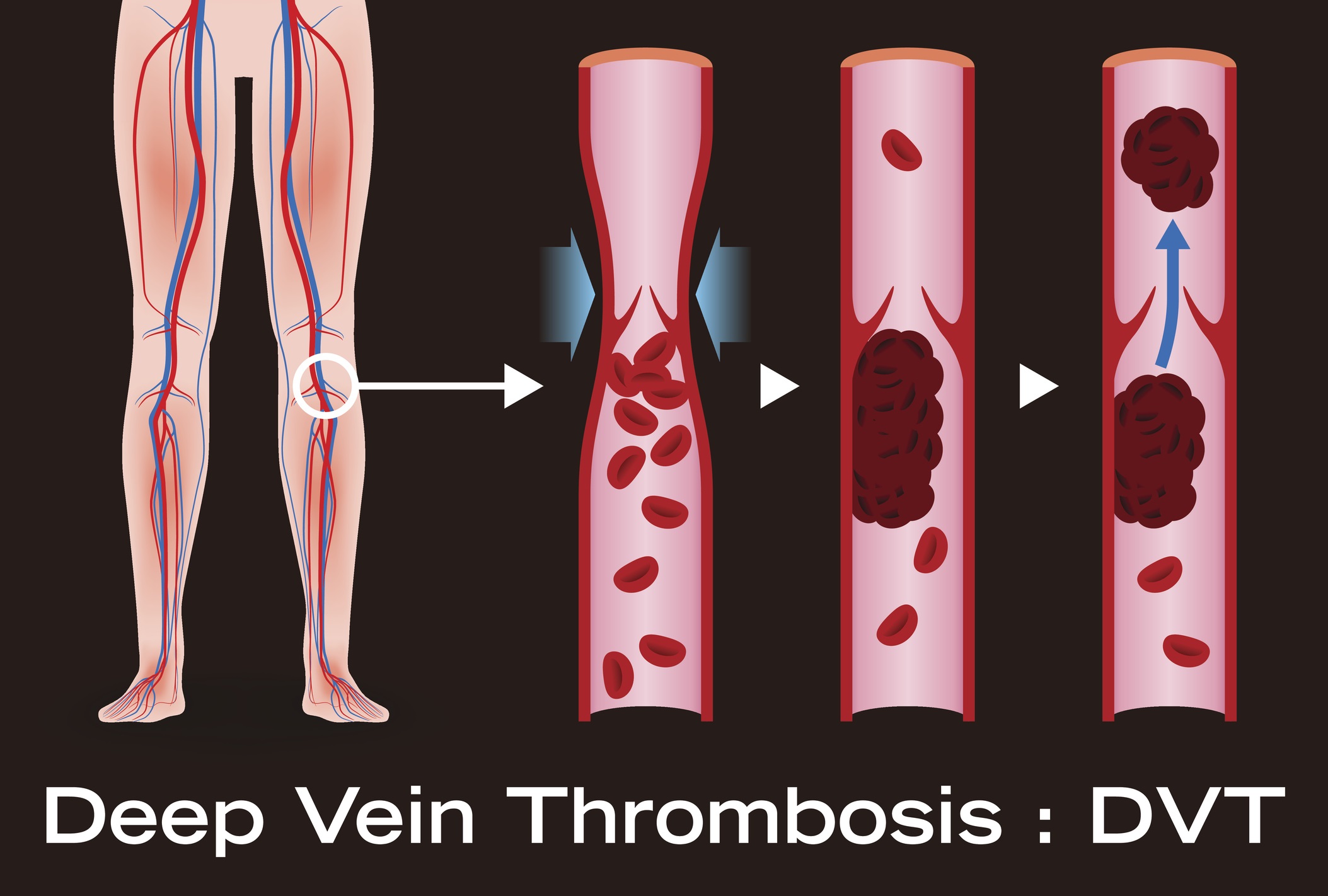 ترومبوز ورید عمقی Deep Vein Thrombosis