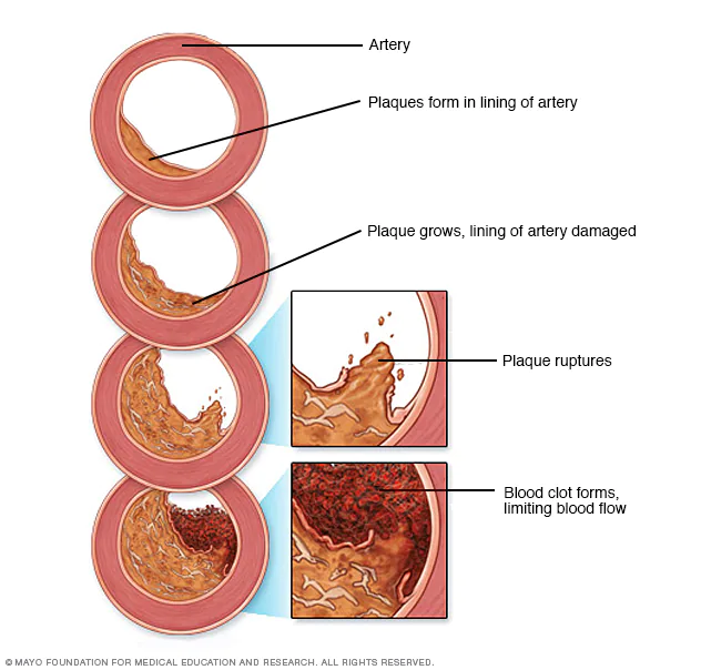 آترواسکلروز و بیماری شریان کرونری Atherosclerosis and Coronary Artery Disease