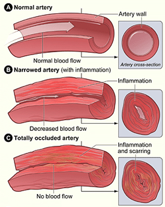 واسکولیت و انسداد و آسیب عروقی ناشی از آن Vasculitis and Inflammation-induced Vascular Occlusion and Injury