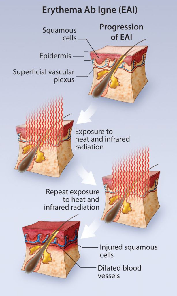 مراحل ایجاد آسیب پوستی در اریتم اب ایگنه Stages of Skin Injury in Erythema ab igne