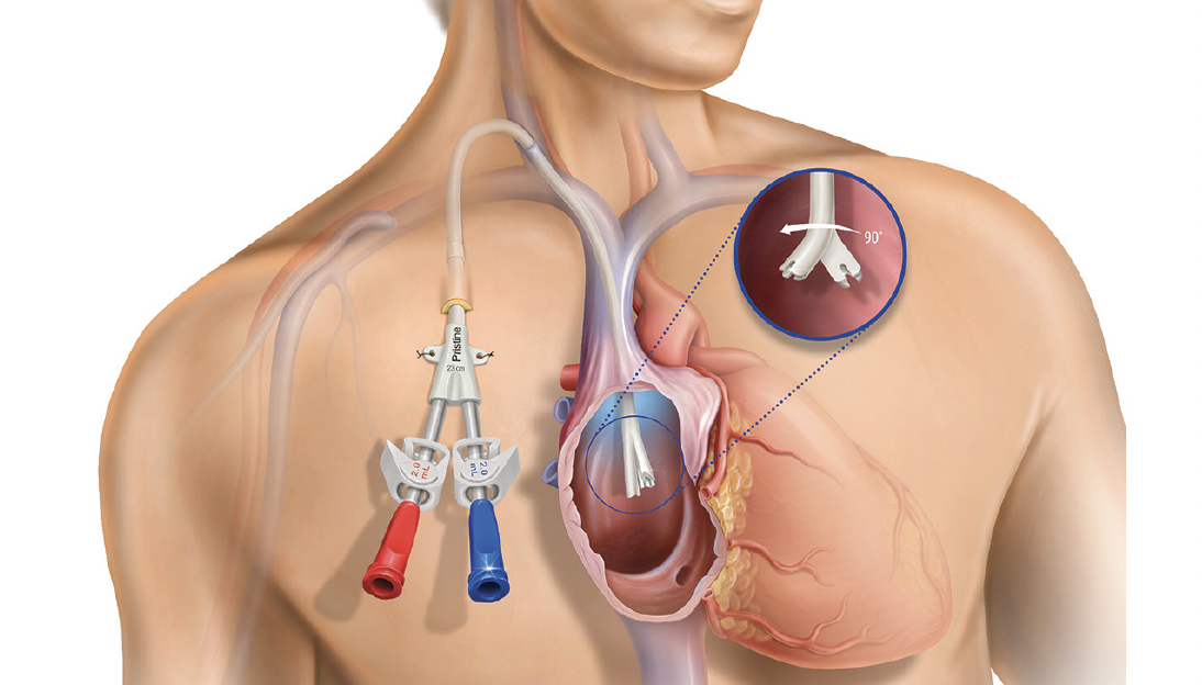 کارگذاری کاتتر ورید مرکزی در دهلیز راست Central Venous Catheter insertion into the Right Atrium