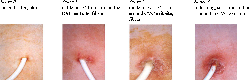 عفونت موضعی مرتبط با کاتتر ورید مرکزی Central Venous Catheter related Local Infection