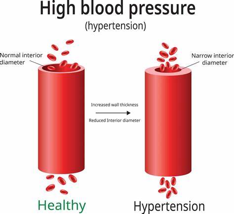 تاثیرات فشارخون بالا در تنگ شدن شریان ها و آسیب شریانی Effects of Hypertension on narrowing lumen of arteries and arterial damage