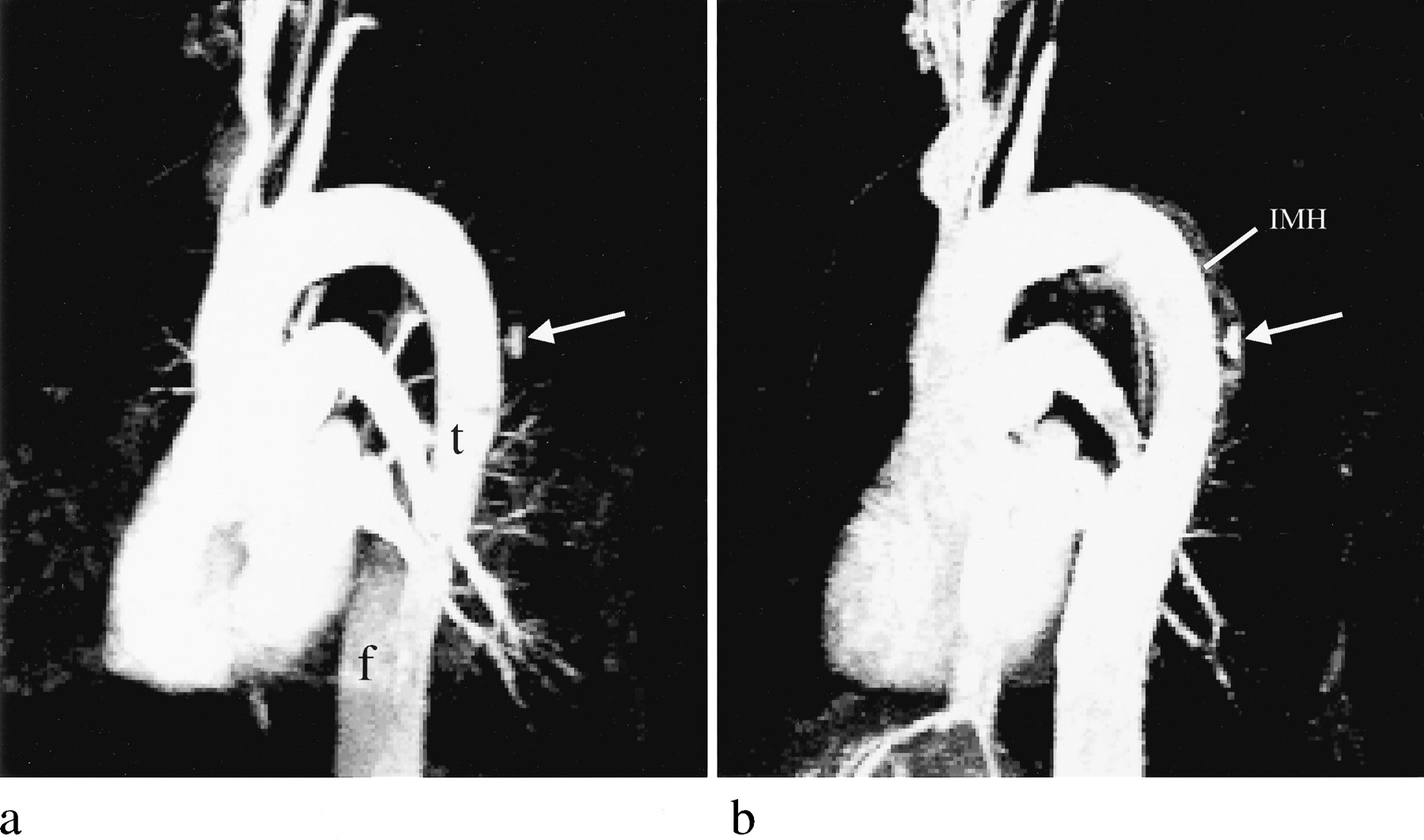 زخم نافذ آئورت در نمای ام آر آی آنژیوگرافی Penetrating Aortic Ulcer in Magnetic Rosnance Angiography (MRA)
