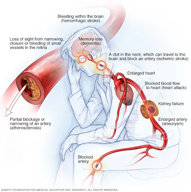 تاثیرات فشارخون بر روی عروق خونی در مناطق مختلف بدن The Effects of Hypertension on Blood Vessels