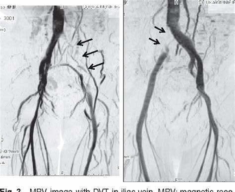 ترومبوز کاتتر در نمای MR ونوگرافی Catheter-related Venous Thrombosis in MR Venography