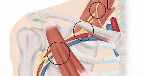 سندروم خروجی قفسه سینه Thoracic Outlet Syndrome