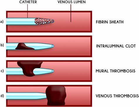 مراحل تشکیل لخته خونی و انسداد عروقی ناشی از کاتتر Stages of Catheter-related Thrombosis and Vascular Occlusion
