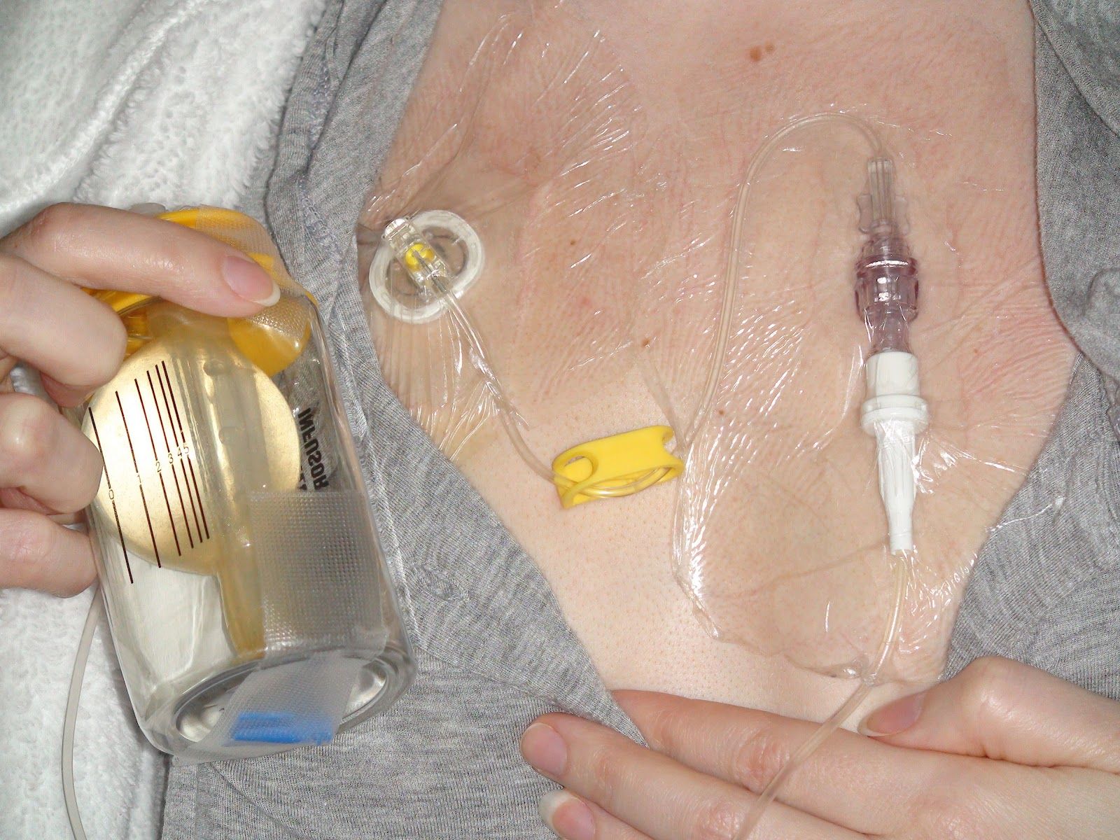 شیمی درمان با کاتتر پورت Port Catheter-mediated Chemotherapy