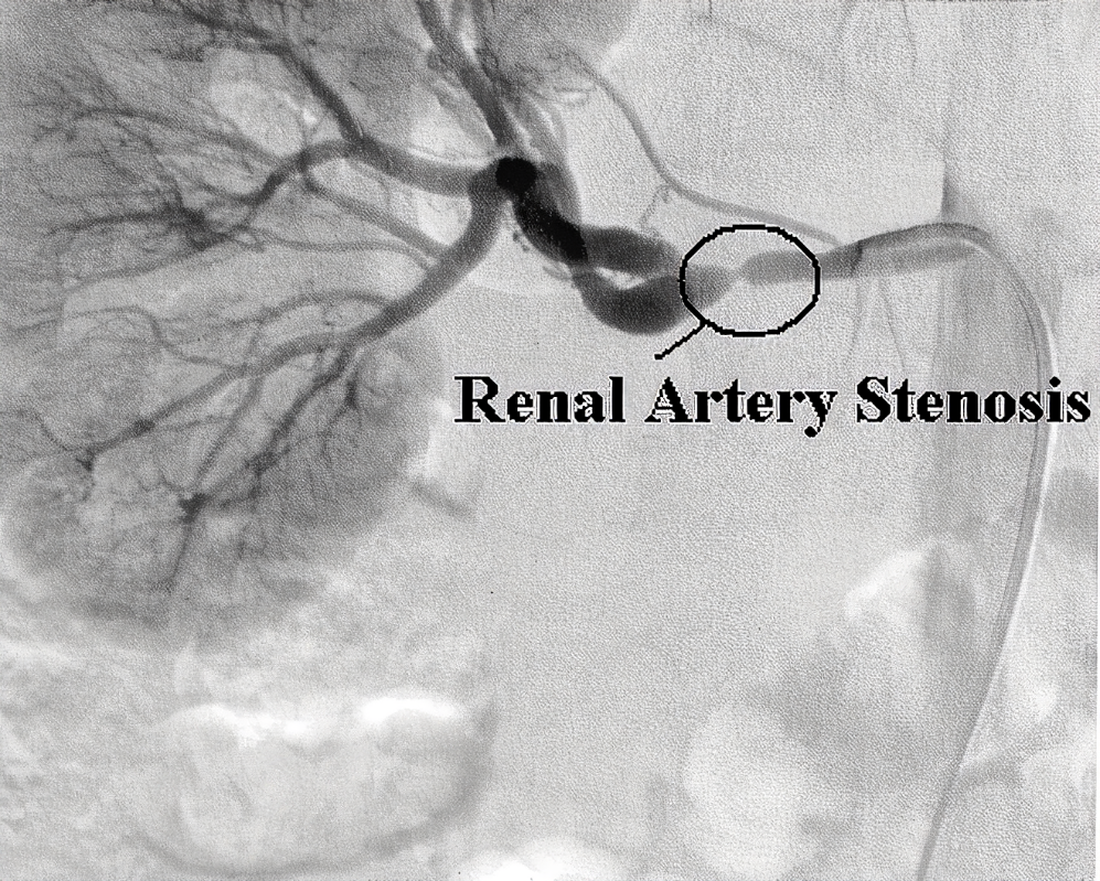 تنگی شریان کلیه راست در نمای آنژیوگرافی Right Renal Artery Stenosis in Angiography