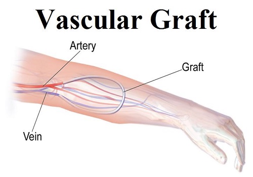 گرافت شریانی وریدی Arteriovenous Graft