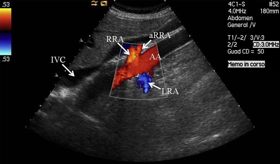 تنگی شریان کلیوی در نمای سونوگرافی داپلر دوپلکس Renal Artery Stenosis in Duplex Doppler Ultrasonography