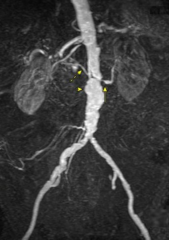 بیماری عروق کلیوی و آنوریسم آئورت اینفرارنال در نمای MRA Renovascular Disease and Infrarenal Aortic Aneurysm in MR Angiography