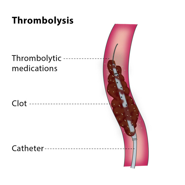 ترومبولیز از طریق کاتتر Catheter-directed Thrombolytic Therapy