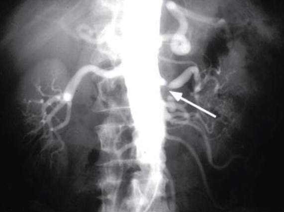 تنگی شریان کلیوی در نمای آنژیوگرافی Renal Artery Stenosis in Angiography