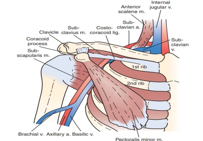 سندروم TOS وریدی Venous Thoracic Outlet Syndrome