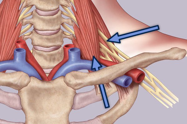 درمان سندروم خروجی قفسه سینه نوروژنیک (TOS نوروژنیک) Treatment of Neurogenic Thoracic Outlet Syndrome