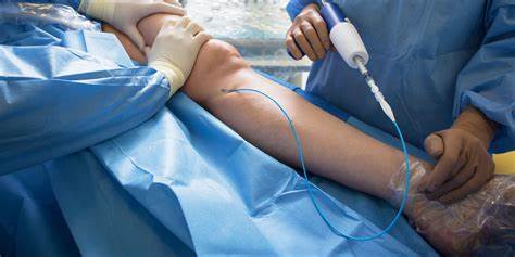 درمان اندووسکولار واریس با لیزر (RF) Endovascular Ablation of Varicose Veins with Radiofrequency